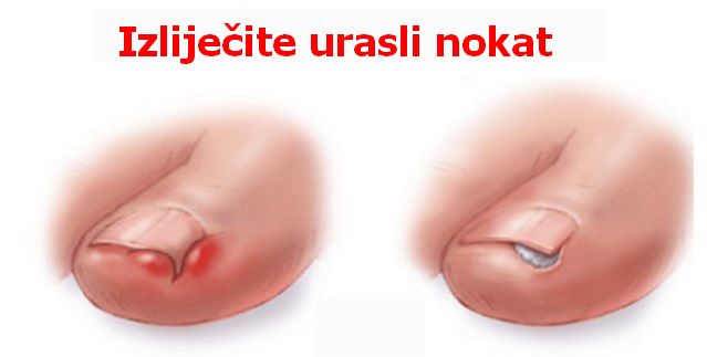 Image result for IZLIJEČITE URASLI NOKAT
