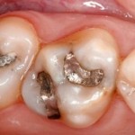 tooth-colored-restorations-before-750x400-590x314