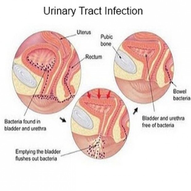 urinary-tract-infection1