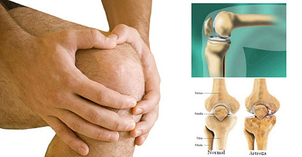 liječenje osteoartritisa koljena masti)