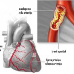 zakrčenje-arterija