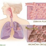 hronična-oboljenja-pluća