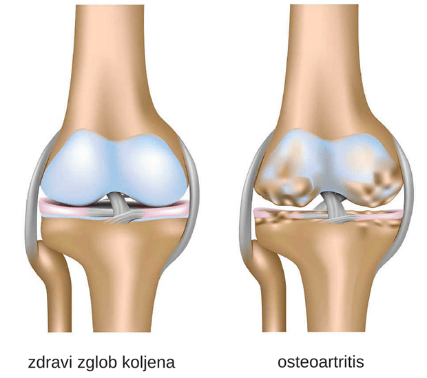 burdock za bolove u zglobu koljena