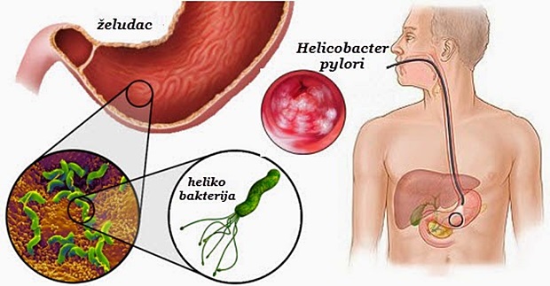 heliko_bakterija_simptomi1