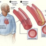 koronarne-arterije