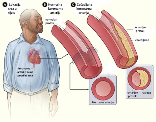 koronarne-arterije