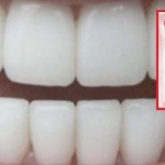 zubi-ciscenje