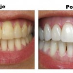 izbjeljivanje-zubi