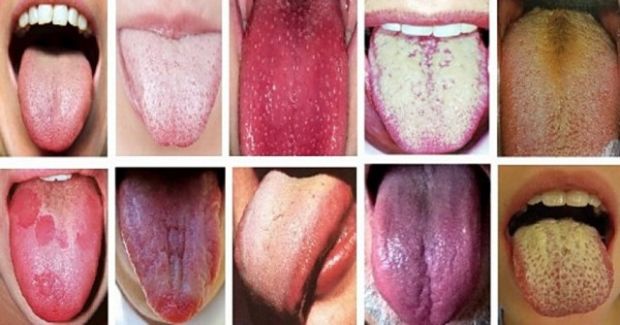 jezik-bolest