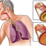 bronhitis