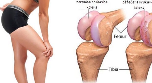 Bolni zglobovi pogoršavaju ostaoartritis koljena - forreststanley.com