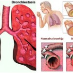 kasalj-bronhitis