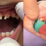djecak-zubi