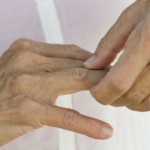 artritis-ruke