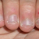 grickanje-noktiju-ostecenje