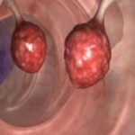 karcinom-debelo-crijevo