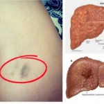 Simptomi-oštećene-jetre