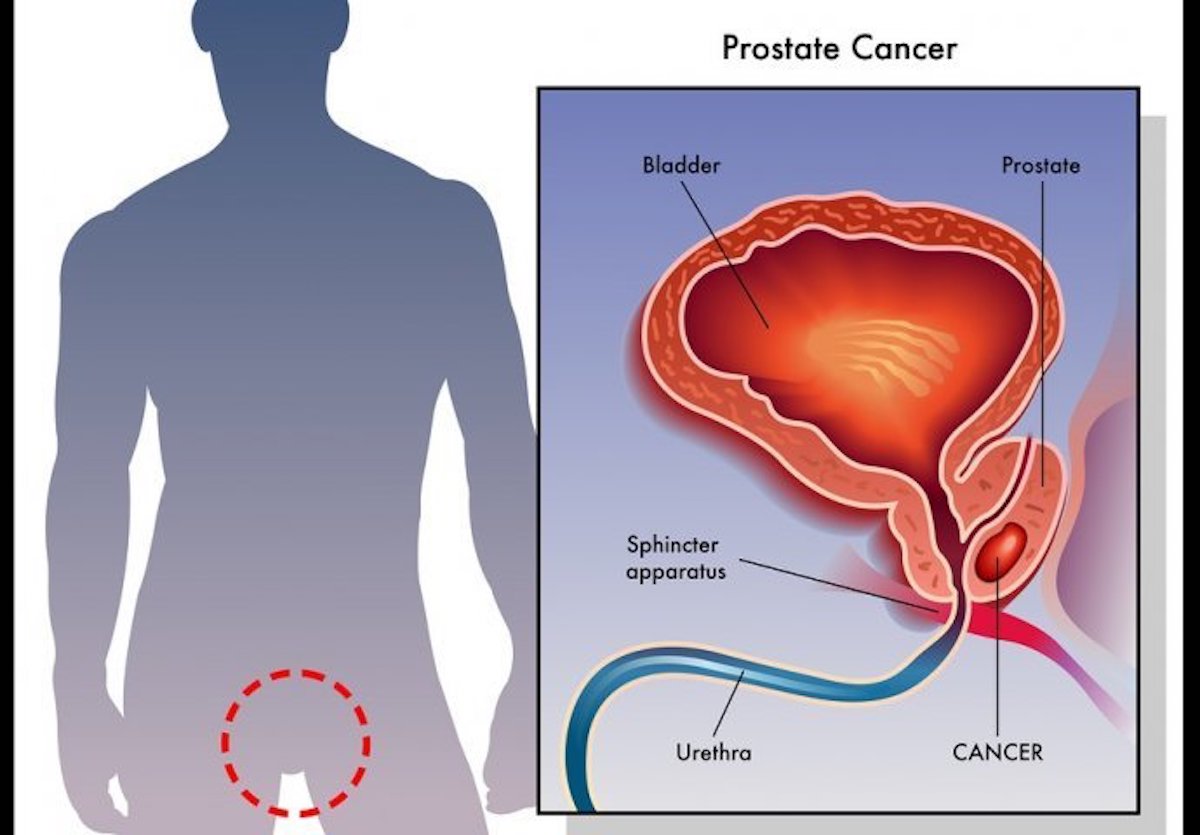 Rak Prostate I Testisa