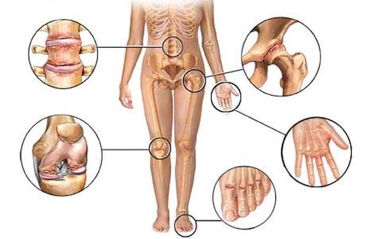 bolovi u zglobovima u kostima i mišićima kupka za liječenje artroze ruku